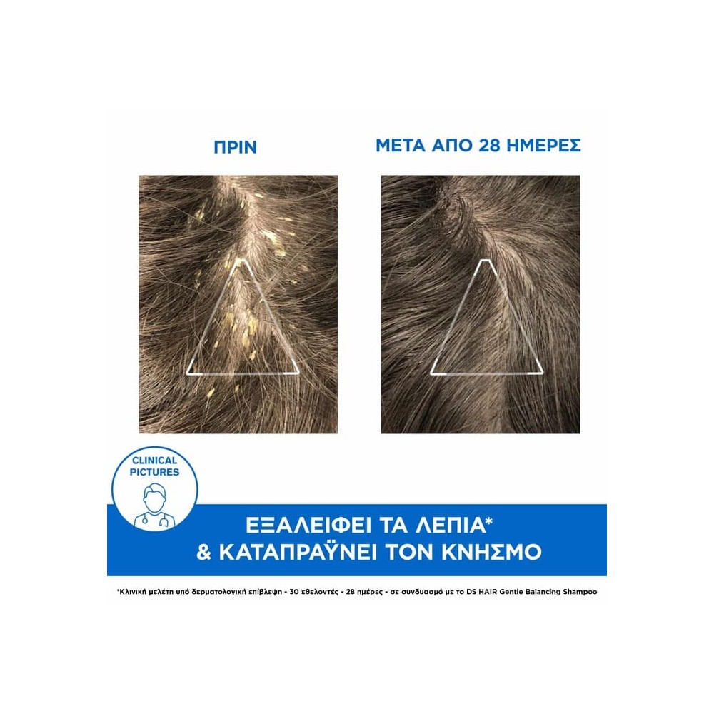 Preview 3 of Uriage Ds Hair Kerato-Reducing Treatment Shampoo Σαμπουάν Αγωγής Κατά της Πιτυρίδας, 150ml